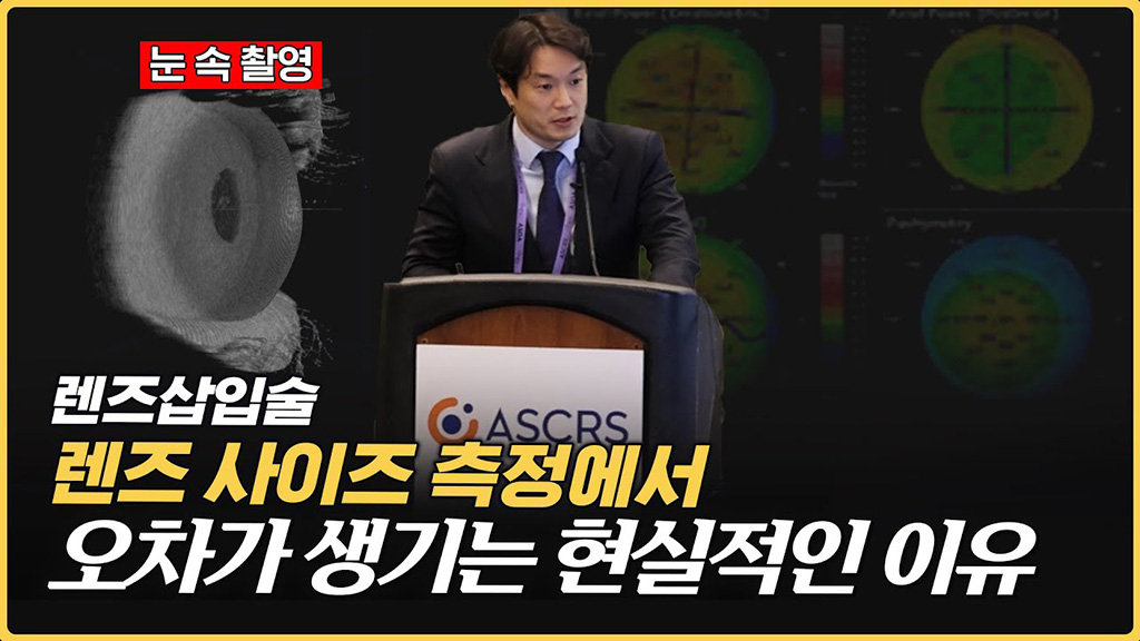 렌즈 사이즈 측정을 잘못하면 벌어지는 일