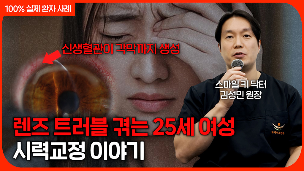 비전가이드 시력교정 이야기ㅣ10년 넘게 렌즈 착용으로 트러블을 겪는 25세 여성
